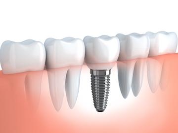Dental Implants Fort Collins