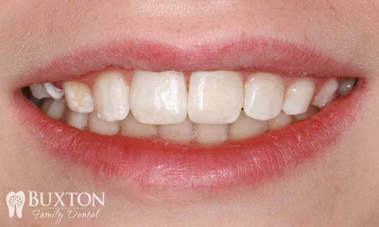 Composite-Bonding-Damaged-Teeth-After-Image