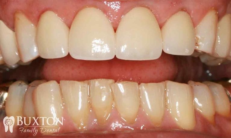 Worn-Teeth-Repaired-with-Crowns-After-Image