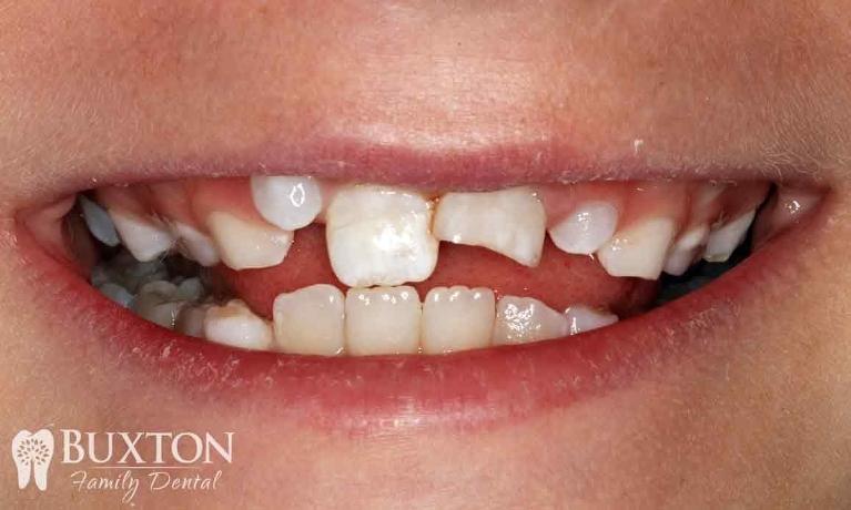 Composite-Bonding-After-Trauma-Before-Image