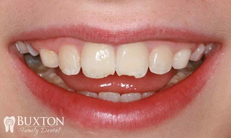 Composite-Bonding-Damaged-Teeth-Before-Image