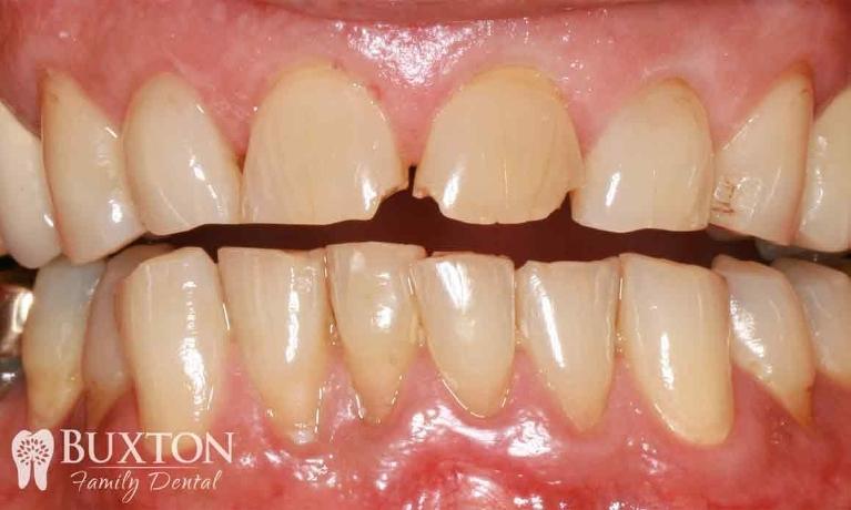 Worn-Teeth-Repaired-with-Crowns-Before-Image